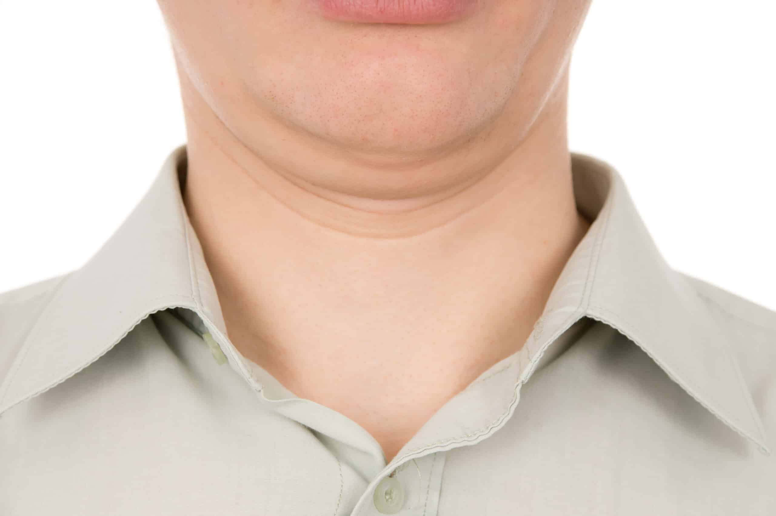 get rid of double chin