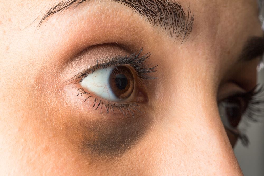 Dark Circles? Eat These 5 Foods & Flaunt Your Eyes Naturally