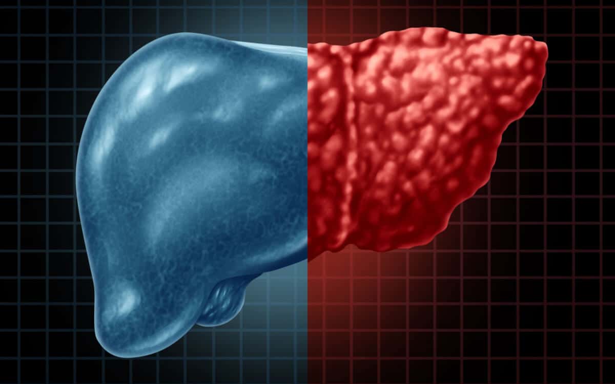 Fatty Liver