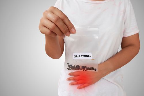 Gallstones