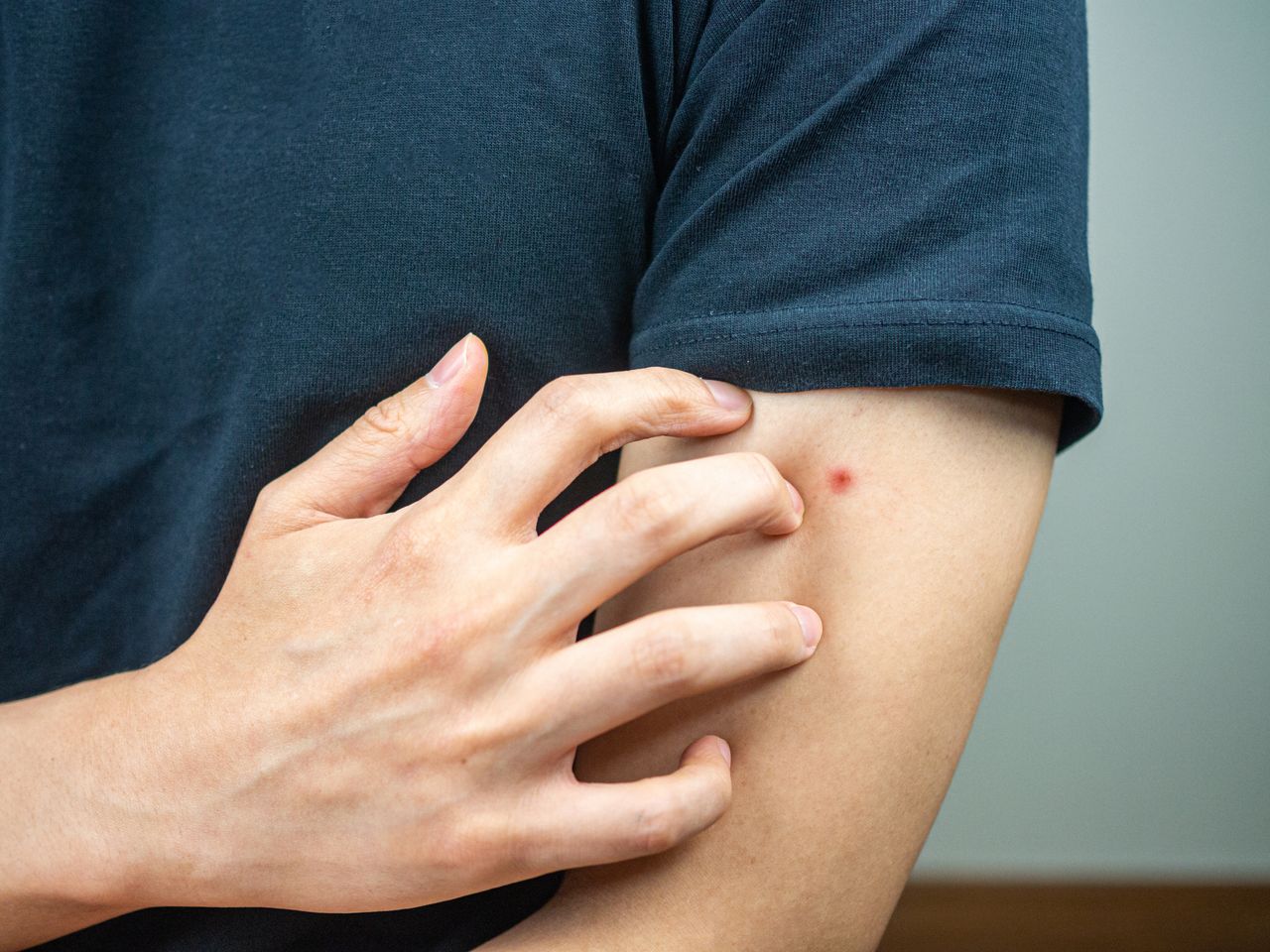 Bug Bites: Here’s Everything You Should Know- HealthifyMe