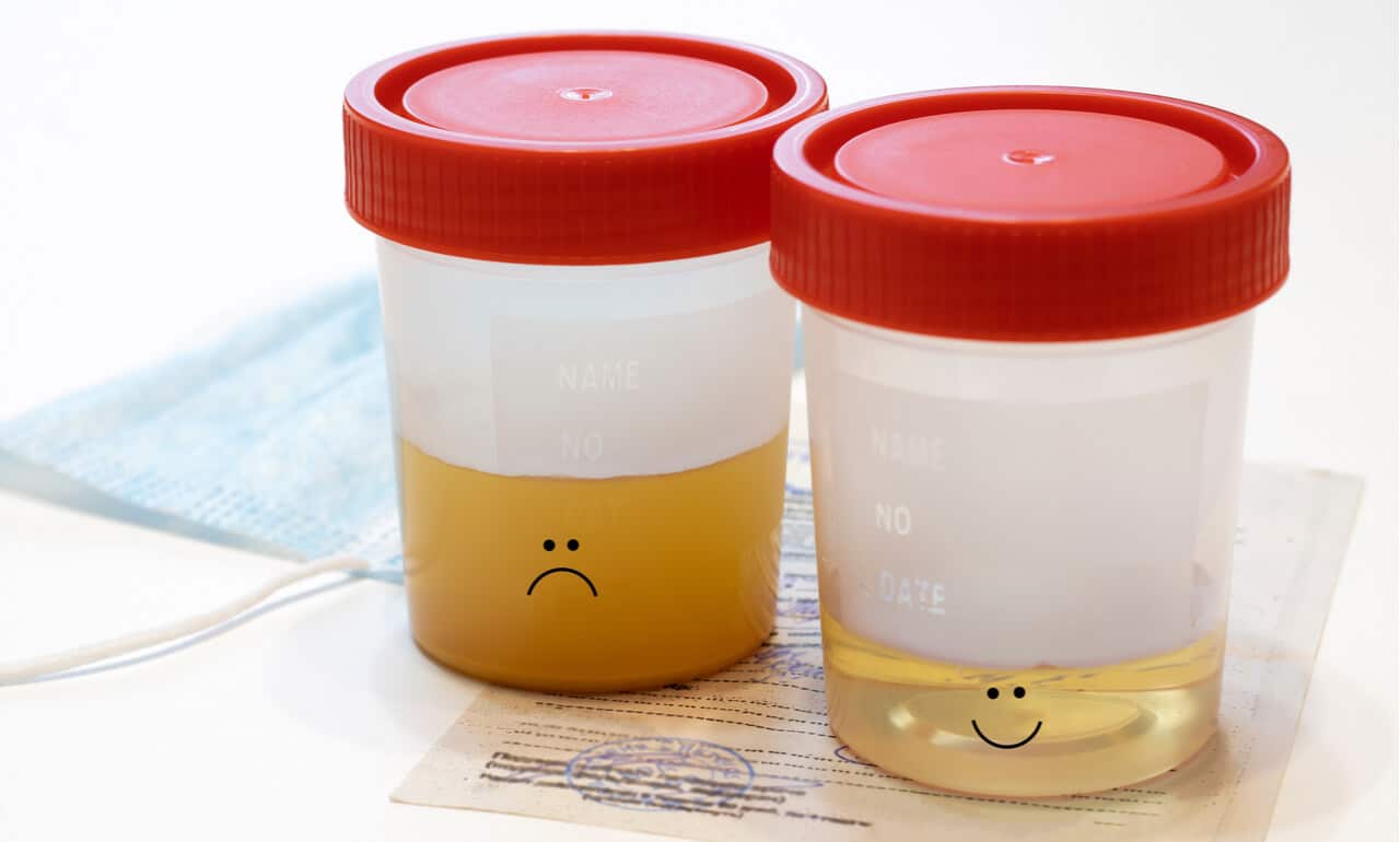 Everything You Should Know About Cloudy Urine - KARKEY