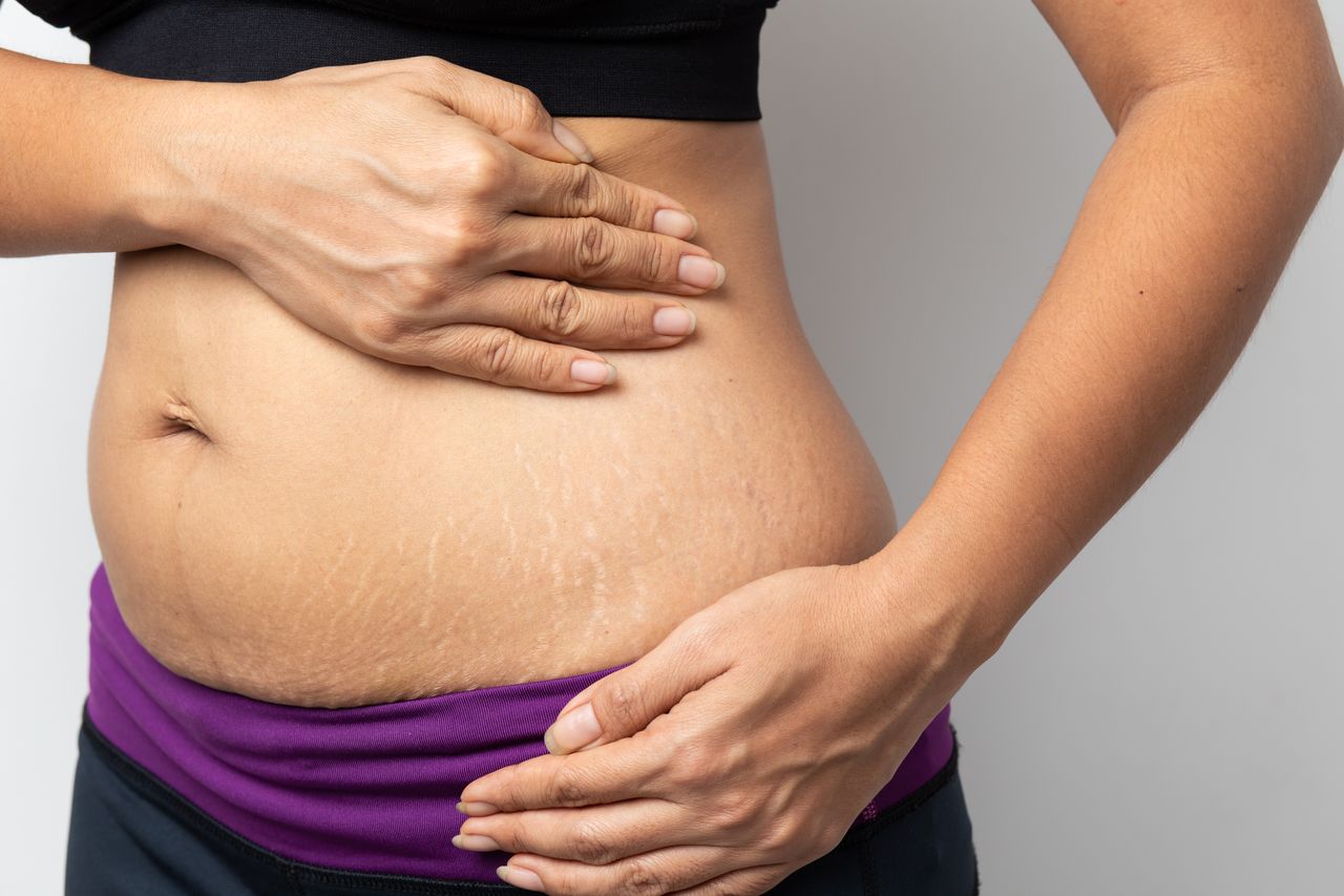 Stretch Marks After Weight Loss: Causes and Preventatives- HealthifyMe