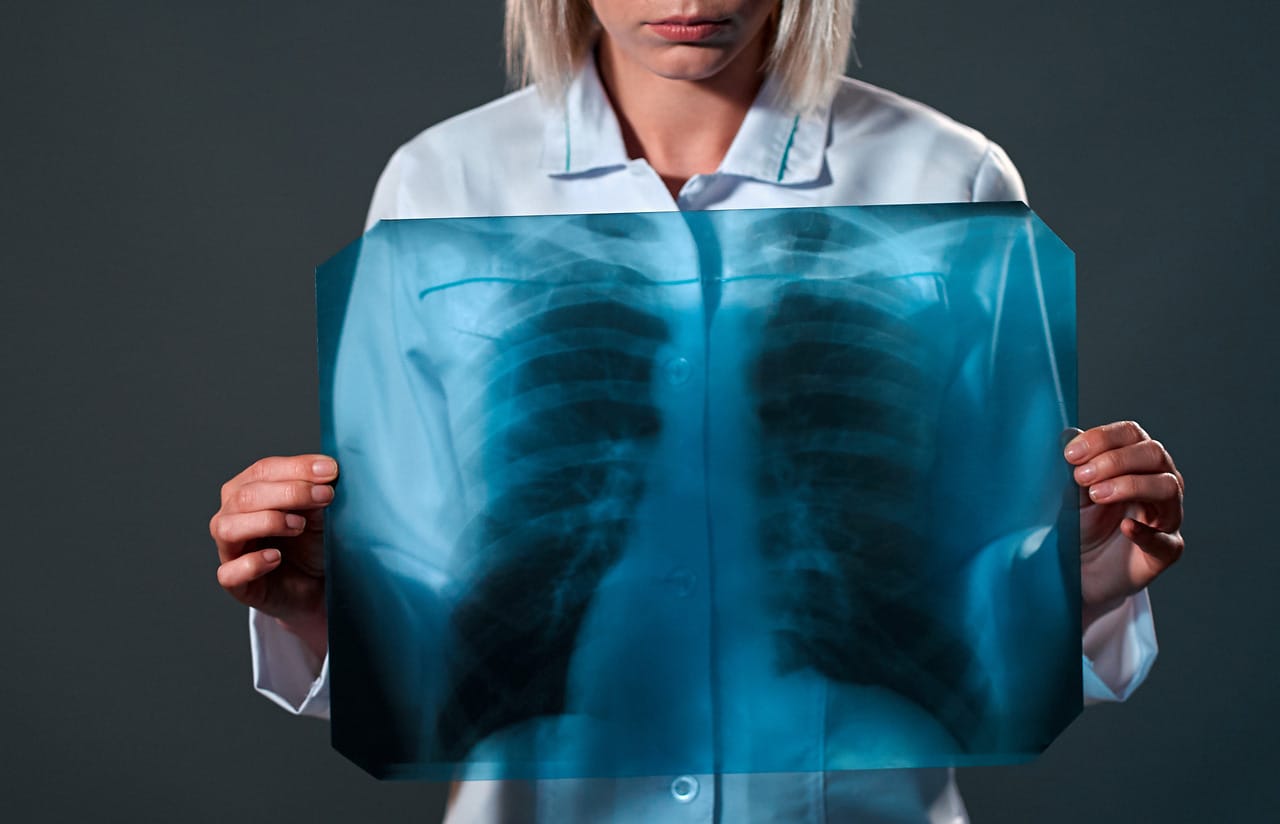 What do we Know about Lung Cancer?- HealthifyMe