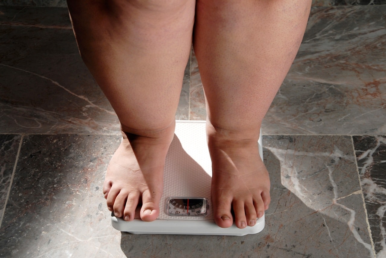 Morbid Obesity: Causes, Treatment and More-HealthifyMe